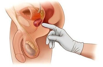 MASAGE -Prostata