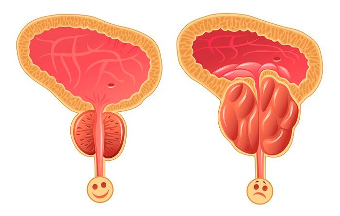 Normale und entzündete Prostata