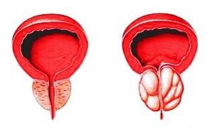 Prostata in normalem Zustand (links) und mit Prostatitis entzündet (rechts)