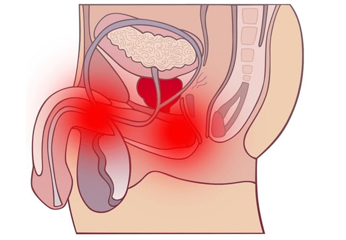 Entzündung des Genitaltraktes mit Prostatitis